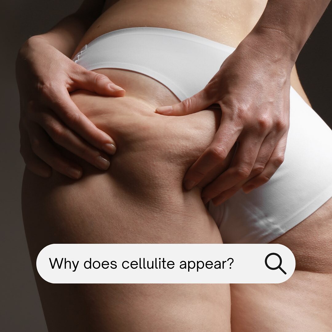 Luxci Body Tip ✍🏽:

Cellulite is one of various metabolic disorders that causes the skin to appear bulging in an irregular way and with a small depressions of subcutaneous tissue of irregular shape which is know as orange peel skin. Usually on the l