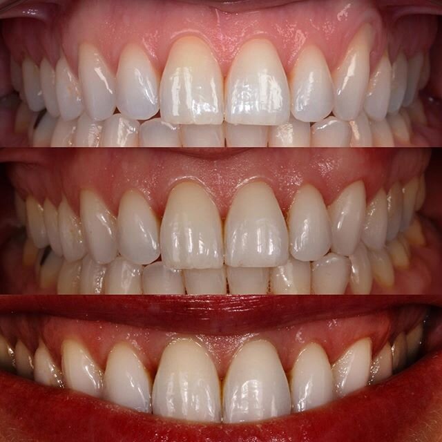 A socially distanced reflection on elective surgeries. Tunnel procedure to cover recession using a SECTG. No relieving incisions to avoid scar formation. Stability at 18 months #perioplasticsurgery #periodontology #surgery #dentist #dentistry #cosmet