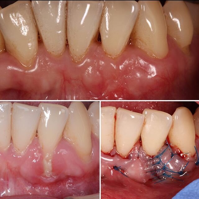 Recession Coverage Monday. Lateral closure with SECTG. The &lsquo;Bernese Concept&rsquo; as coined by Anton Sculean #periosurgery #perioplasticsurgery #plasticsurgery #periodontology @perioworld #dentist #dentistry #dentalsurgery #gumsurgery #gumrece