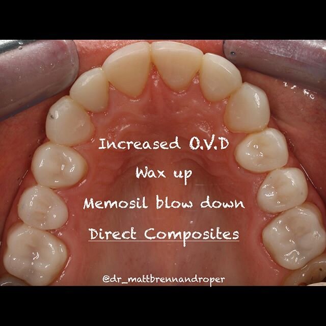 Direct composites in TSL. Functional and cost effective for younger patients. #2ndtimelucky #compositerestoration #compositebonding #compositephotography #compositeveneers #composite #composites #compositefilling #bonding #dental #dentist #dentistry 