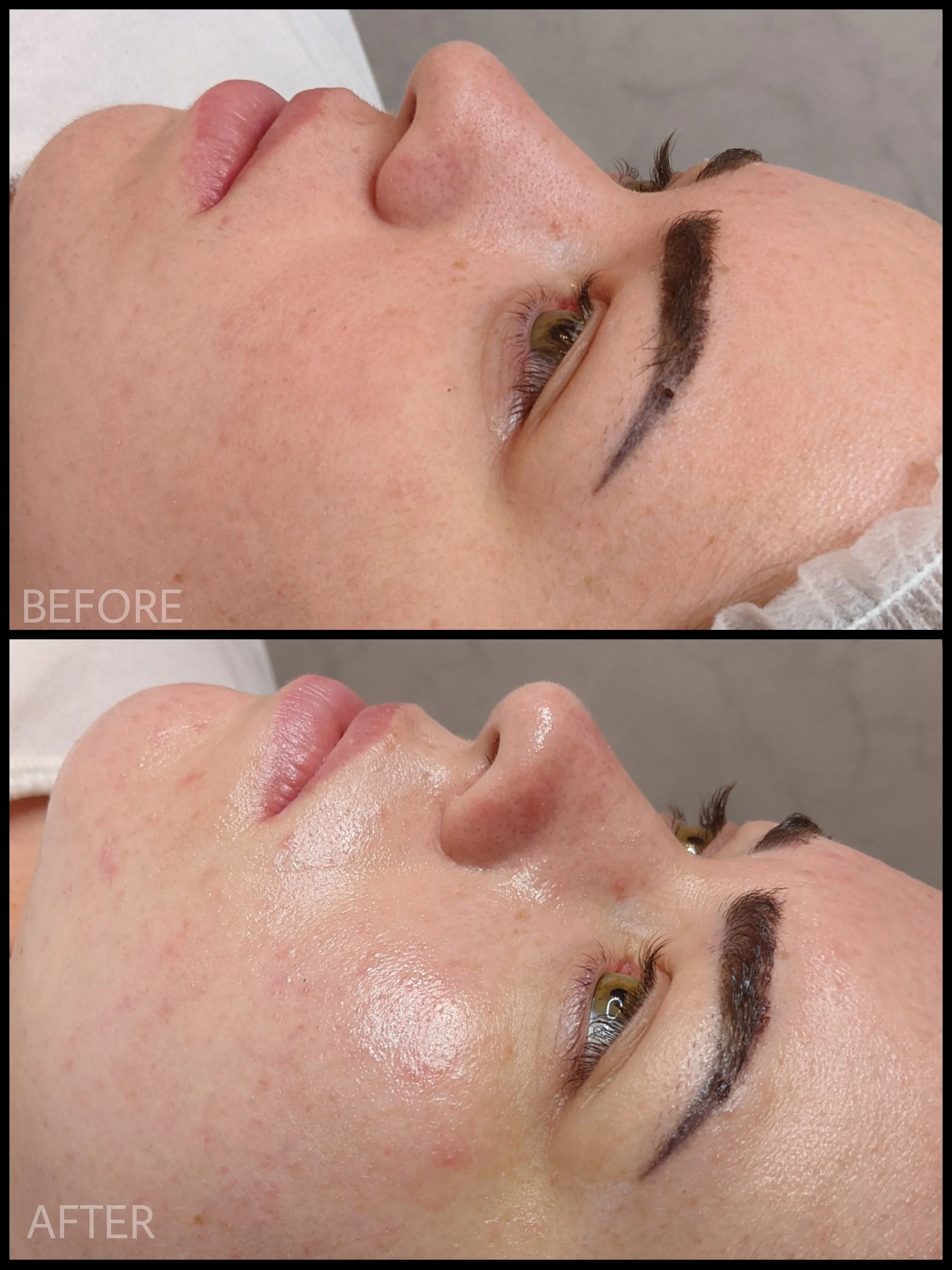 chemical peel near me - sunderland - durham - skincare routine