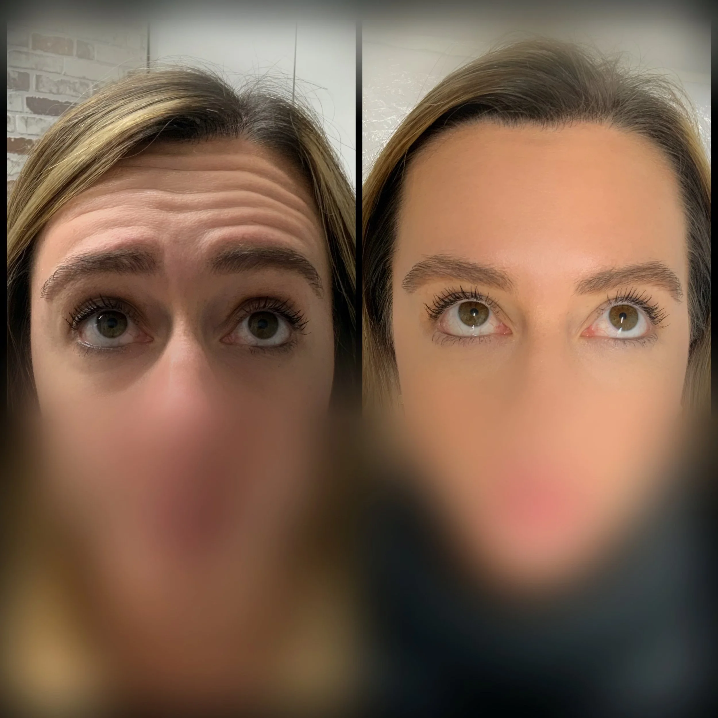 Botox near me - skincare routine