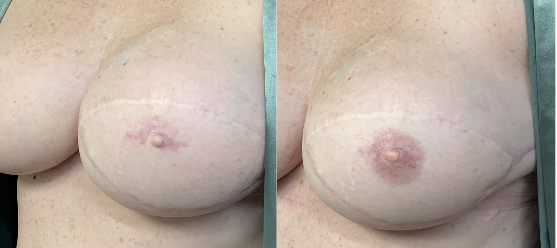 Close-up of a person's breasts showing scars and skin discoloration.