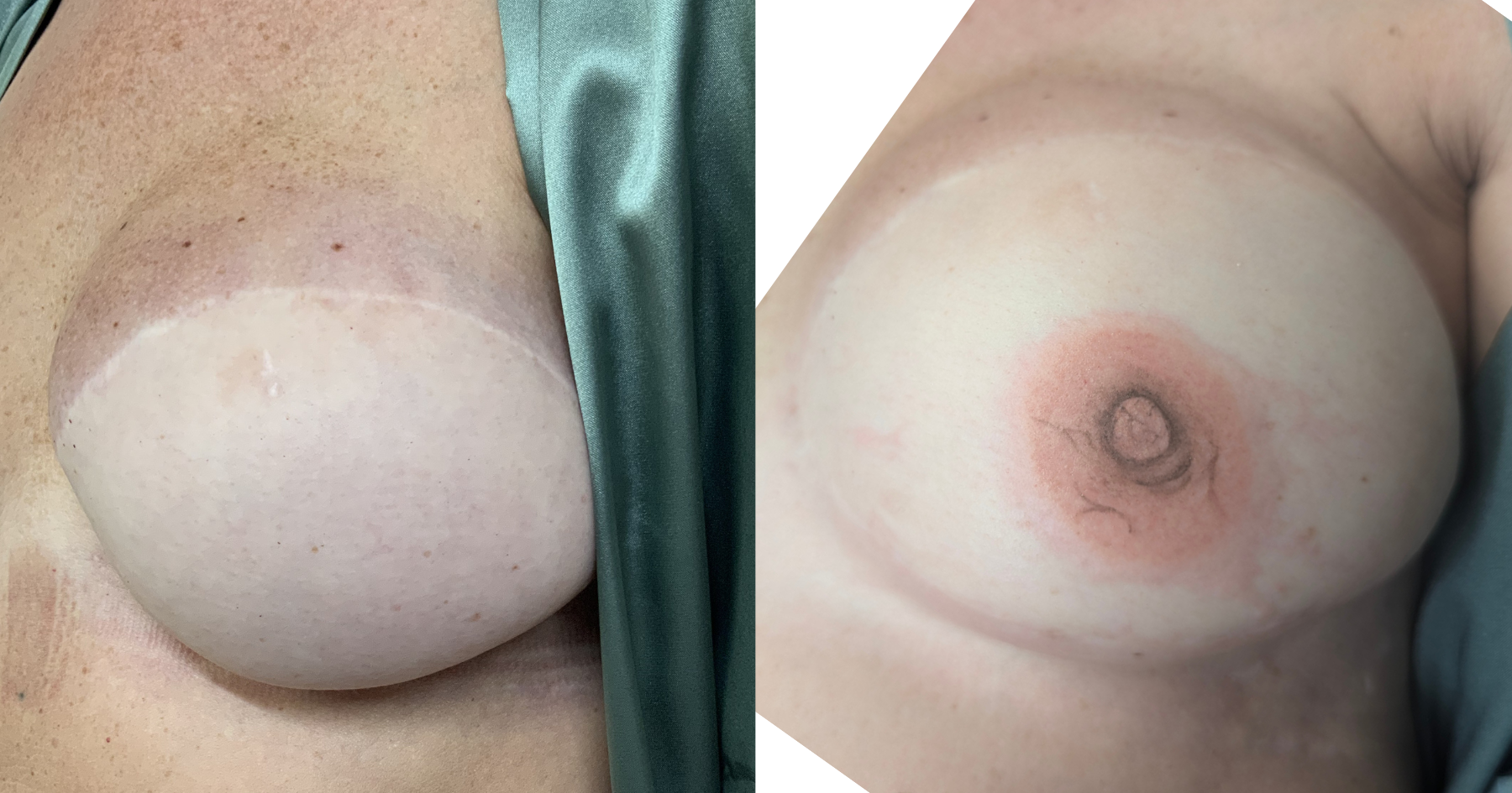Close-up of a person's nipple and surrounding skin, showing natural skin texture and coloration.