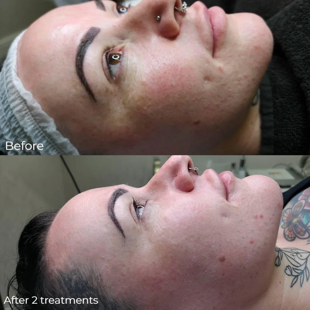 Microneedling north east skincare routine