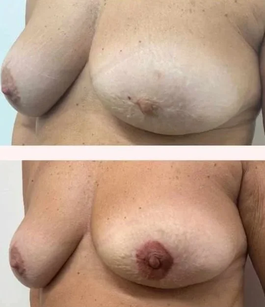 Close-up of a woman's bare chest before and after nipple reconstruction, showing the difference in nipple appearance.