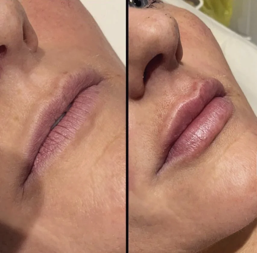 Filler near me - sunderland - durham - skincare