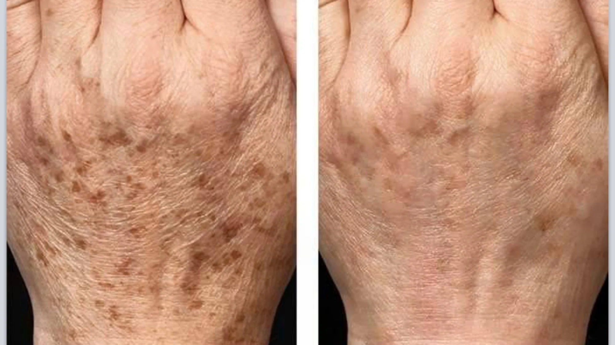 Age spot removal Omagh