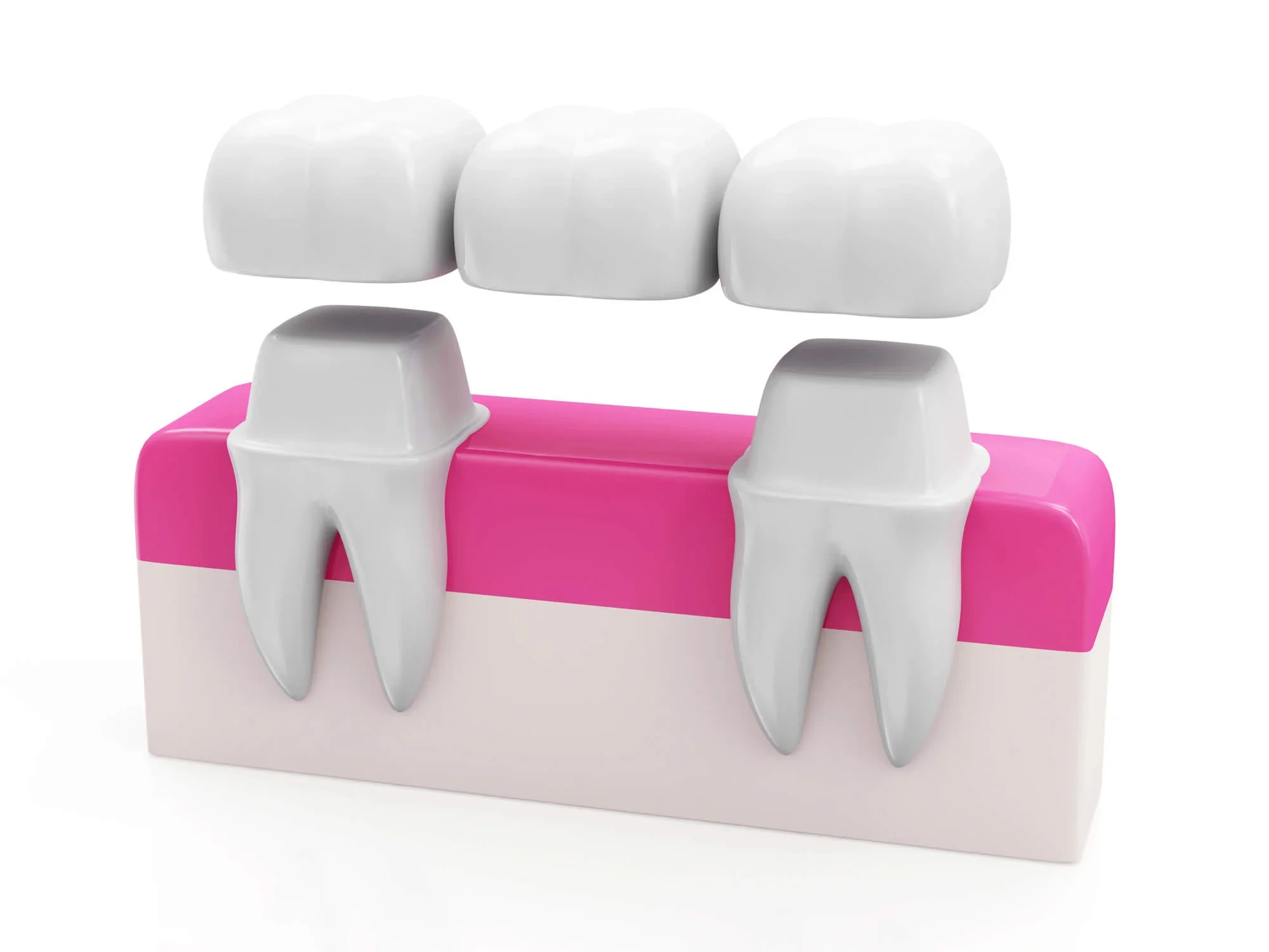 Concept of dental bridges in Lynn Haven, FL.