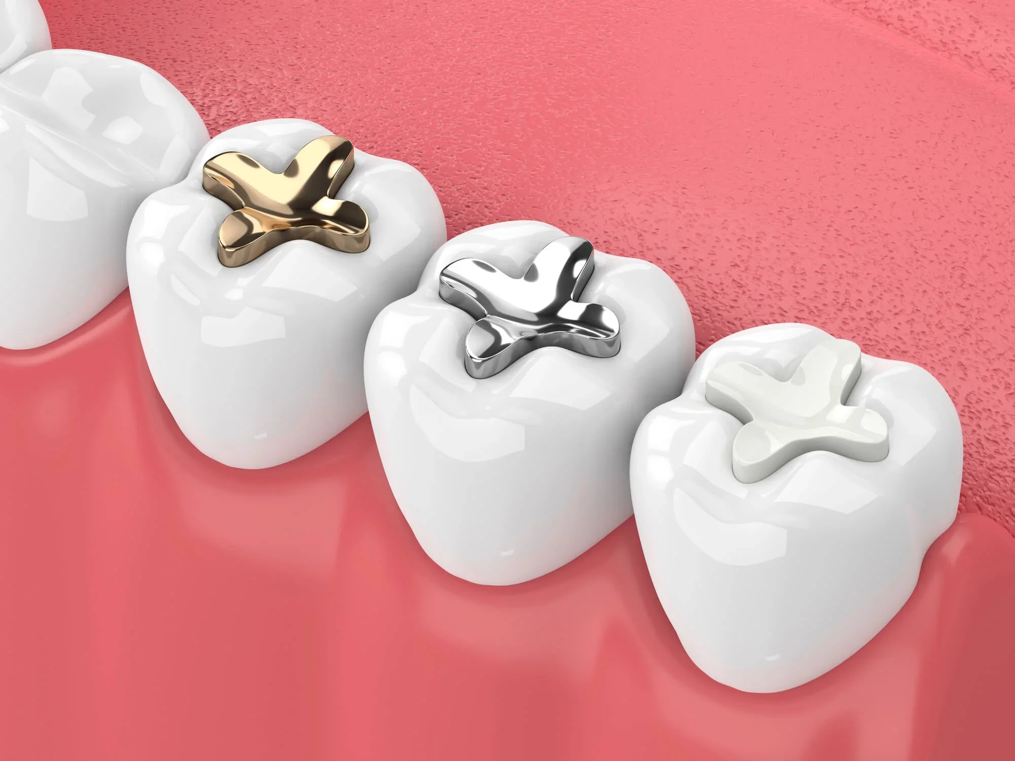 Signs You May Need Tooth Fillings Right Away 