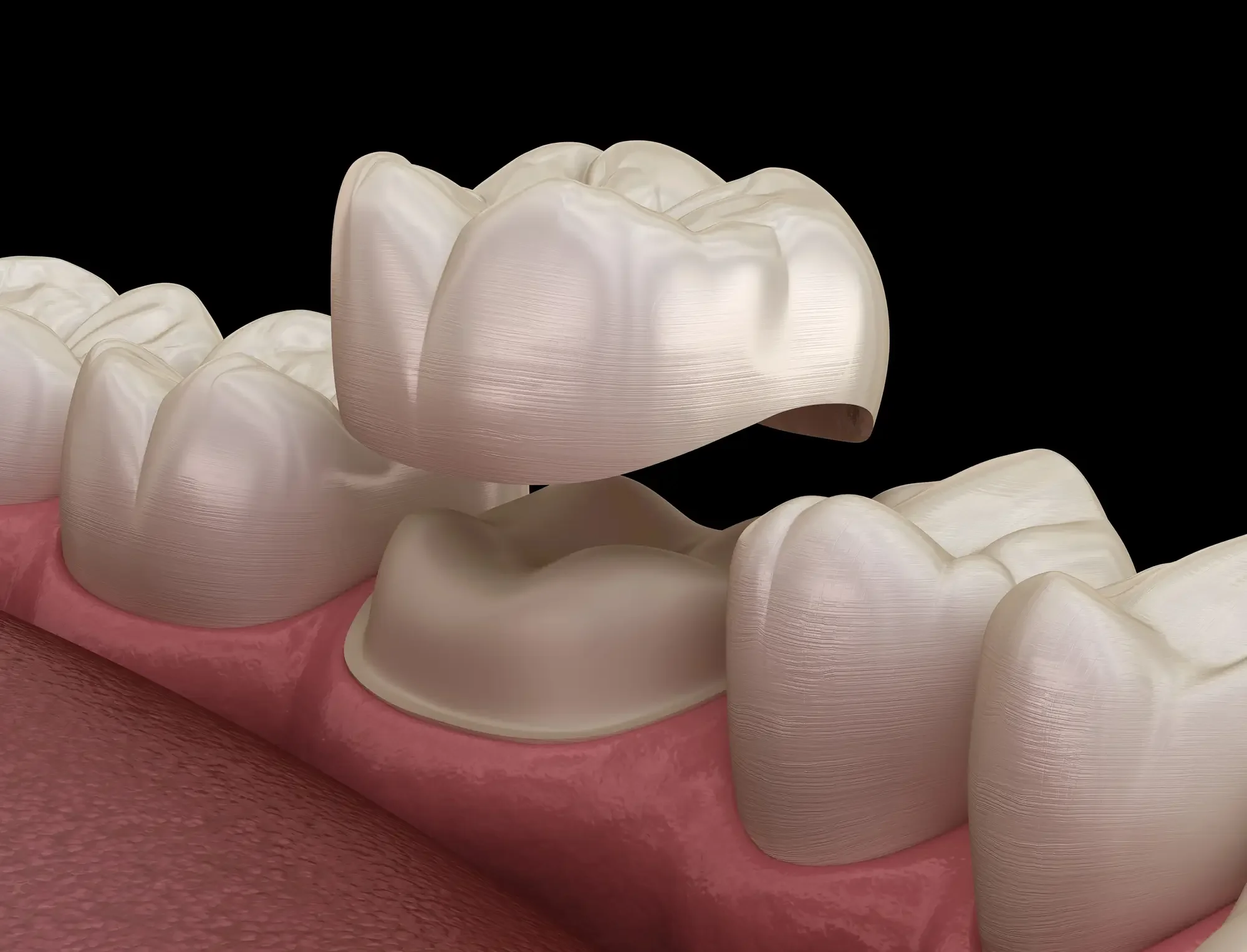 5 Signs You Might Need a Dental Crown