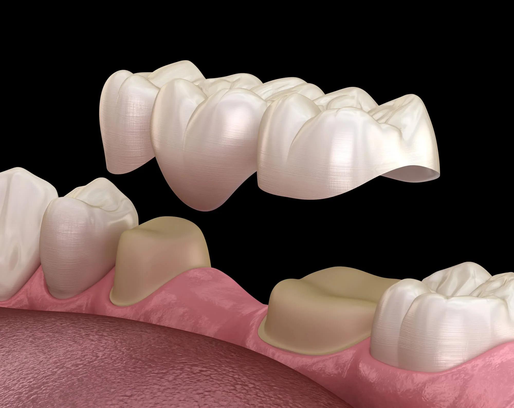 Illustration of dental bridges in Lynn Haven, FL.