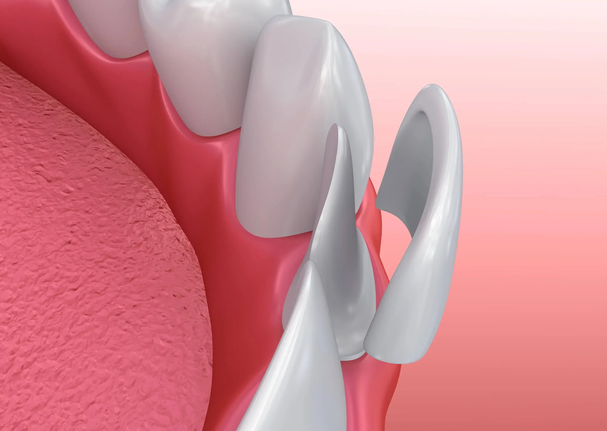 3D illustration of veneers in Panama City, FL.