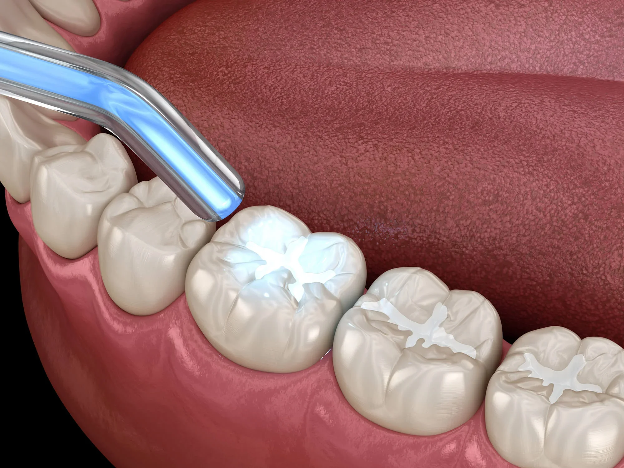 Tooth fillings in Lynn Haven, FL