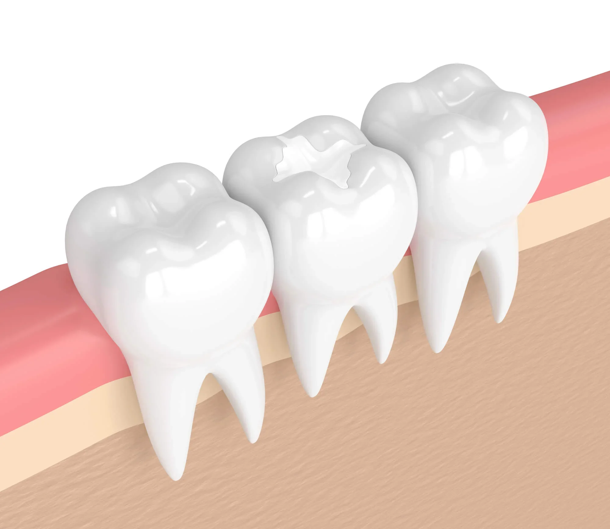 Illustration of tooth fillings in Lynn Haven, FL