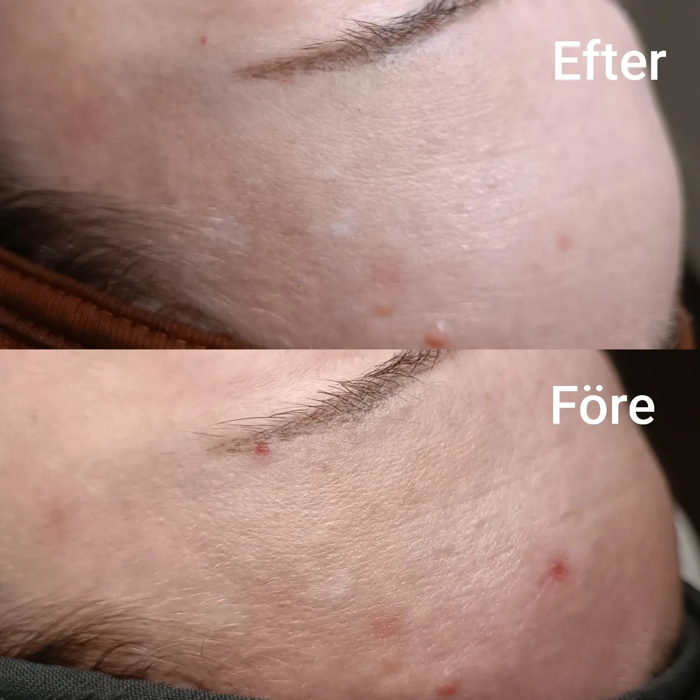 Efter en behandling med SkinPen har vi f&aring;tt en mjukare, sl&auml;tare hud med j&auml;mnare ton och struktur!

En m&aring;nad mellan bilderna

@skinpen_sverige #skinpensverige #skinpen #microneedling #microneedlinglidk&ouml;ping