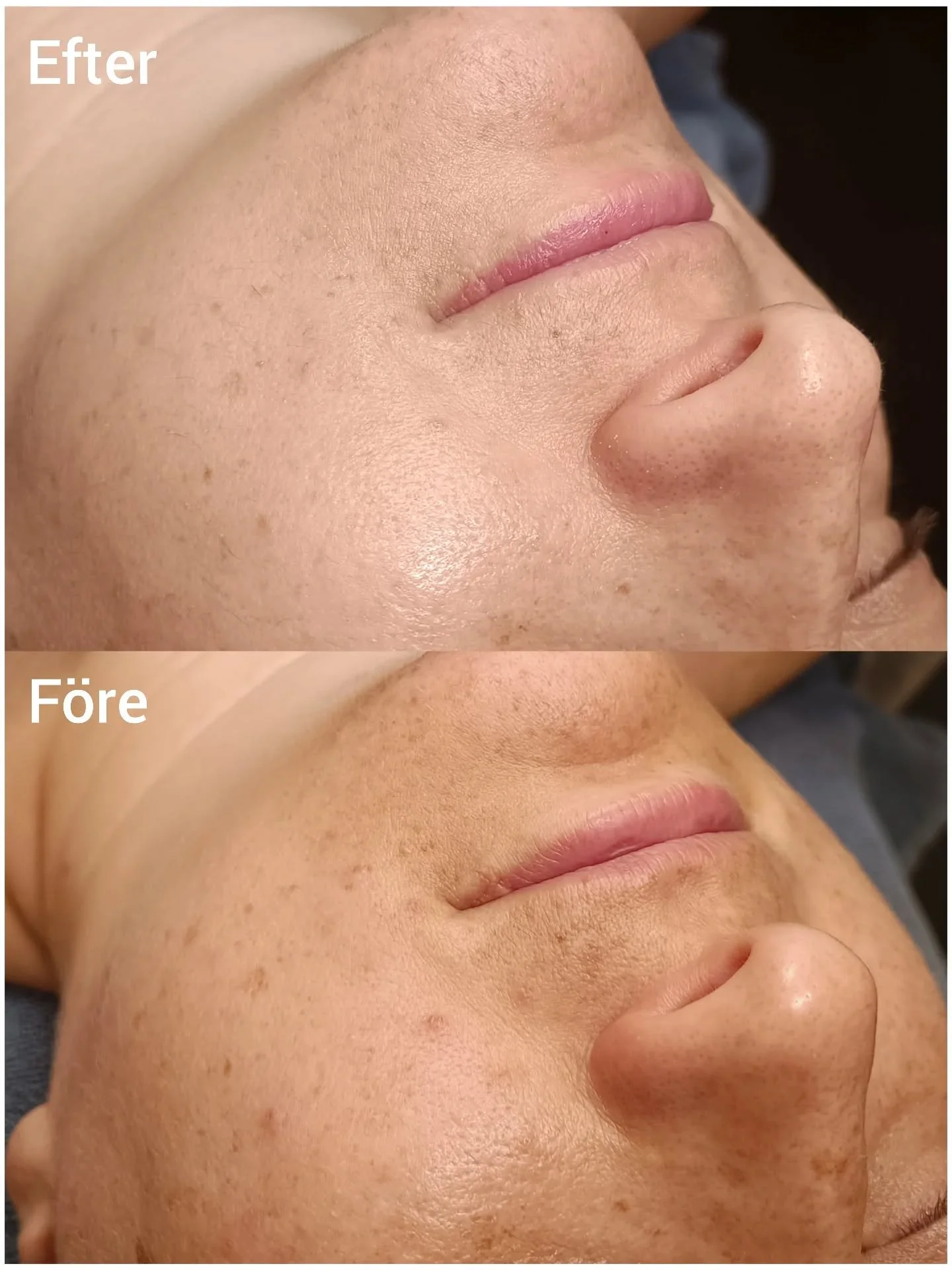 Hudresa! P&aring; 6 m&aring;nader har vi f&aring;tt s&aring; otroligt fint resultat! Regelbundna behandlingar med bland annat 2 st SkinPen microneedling.

#hudv&aring;rdmedenplan #hudv&aring;rdmedresultat #hudterapeut #hudterapeutm&auml;stare #lidk&o