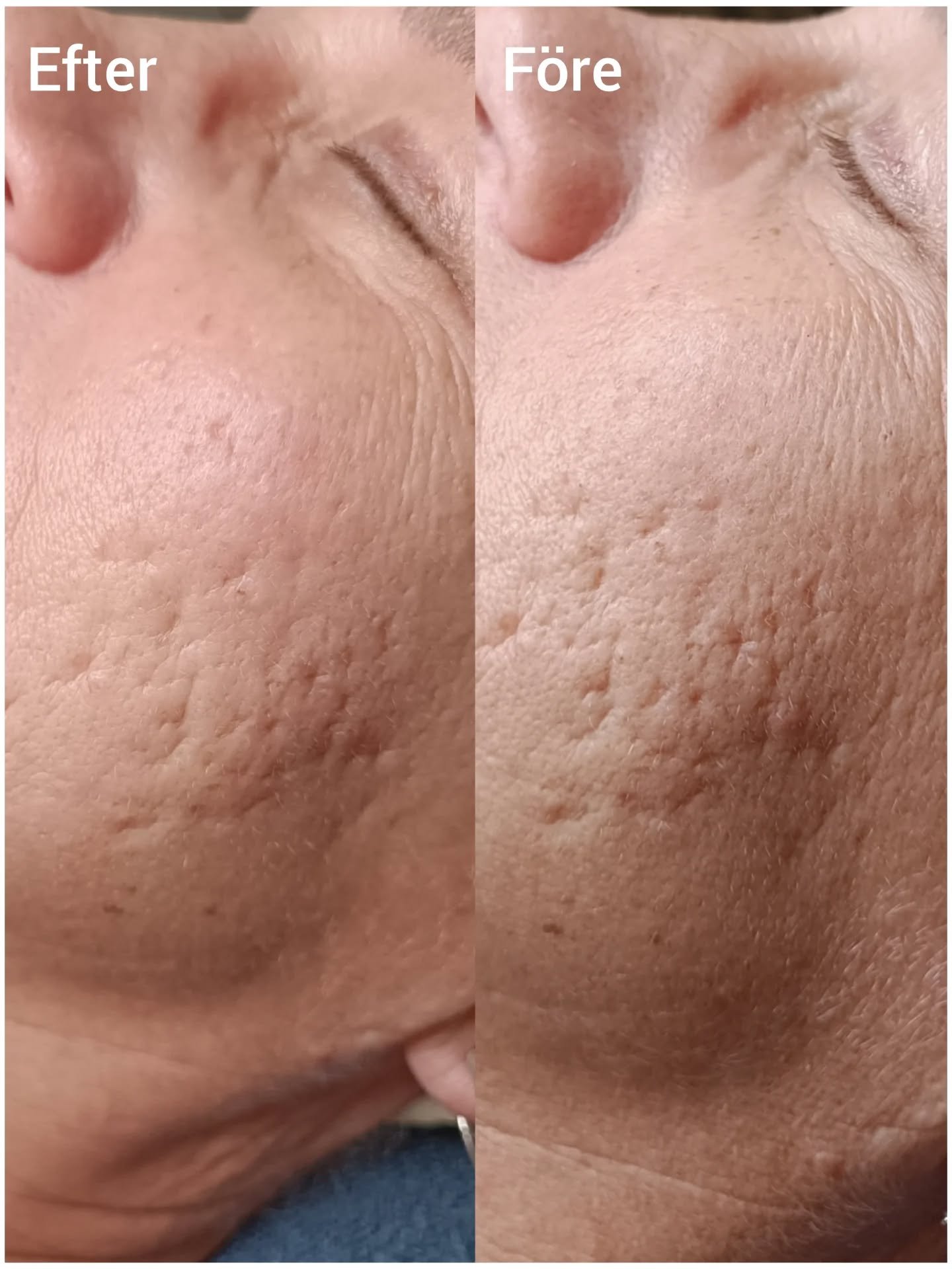 En kund som b&ouml;rjat nya &aring;ret med mjukare, friskare och sl&auml;tare hud.

Vi har gjort en SkinPen f&ouml;r en m&aring;nad sen med fokus p&aring; &auml;rr, inkapslingar och hudf&ouml;ryngring.

&Auml;rr tar tid men redan efter en behandling 