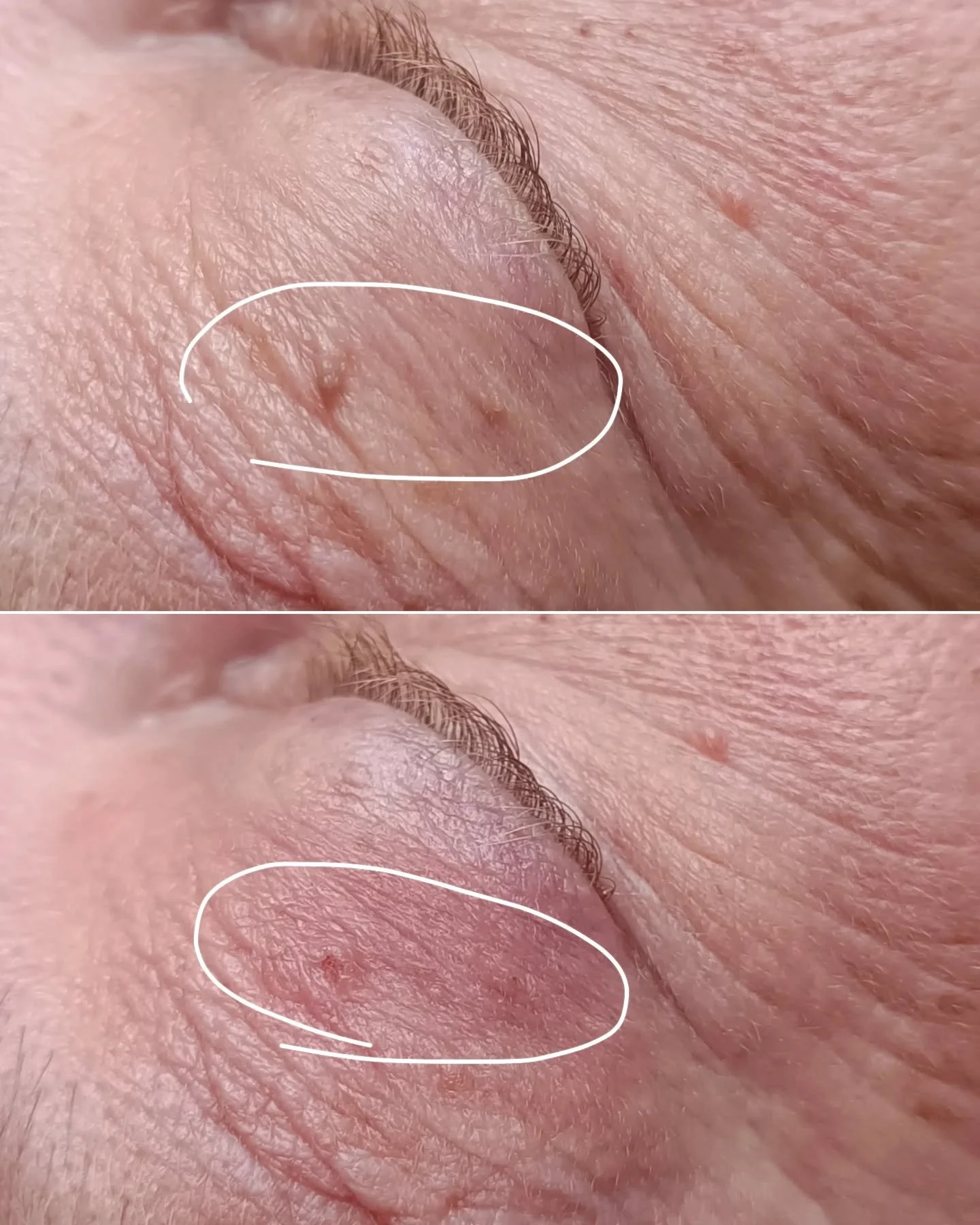 Sm&aring; skin tags p&aring; &ouml;gonlocket. Dessa tar vi snabbt och l&auml;tt bort med diatermi 

R&auml;kna med lite rodnad och eventuell skorpa i n&aring;gra dagar