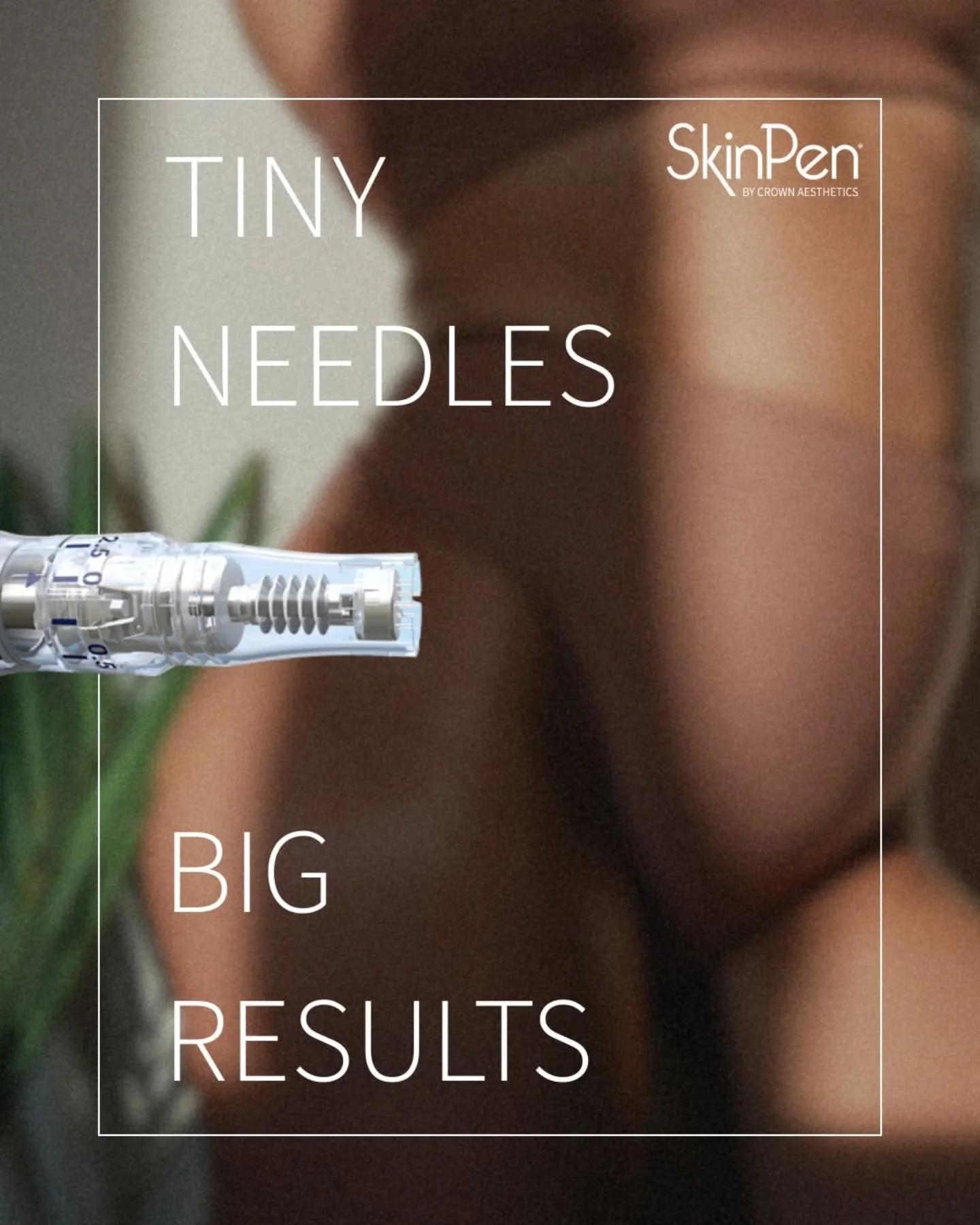 Vetenskapsbaserad sk&ouml;nhet. SkinPen aktiverar kroppens naturliga l&auml;kningsprocess f&ouml;r verkliga resultat.

Ger extra fint resultat p&aring; &auml;rr och oj&auml;mn hud.

Reposted from @skinpen_sverige