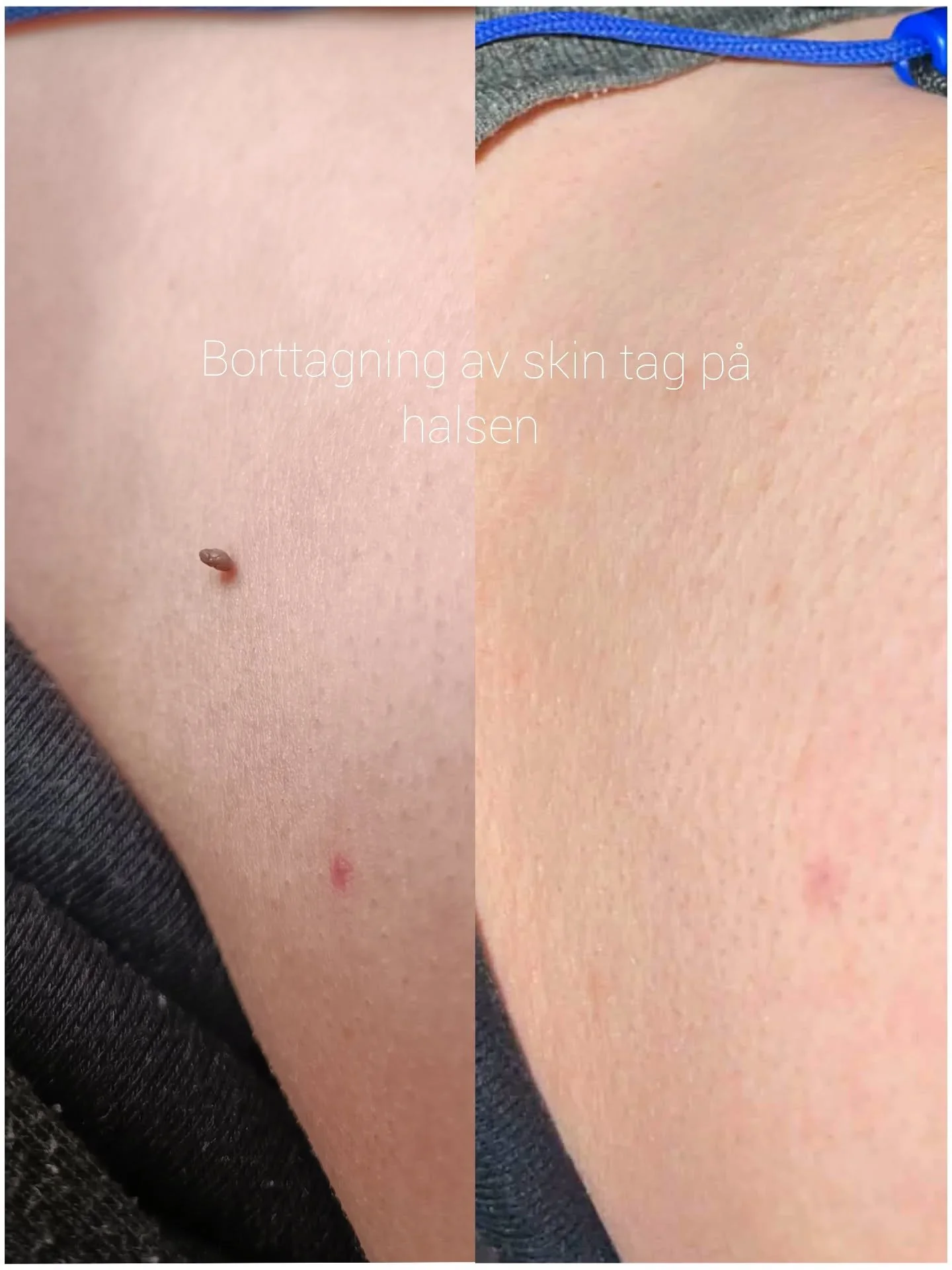 F&ouml;re och n&aring;gra dagar efter borttagning av skin tag p&aring; halsen. Det &auml;r sv&aring;rt att se var den suttit ☺️