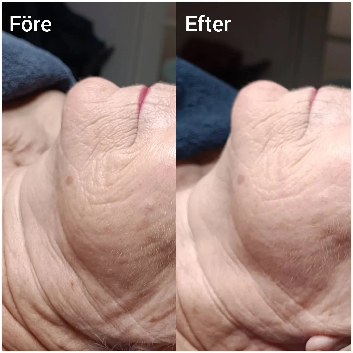 Mjukare och fastare hud efter 2 st B peel &ouml;rtpeeling 💚
2 m&aring;nader mellan bilderna.

Detta &auml;r en fantastisk och effektiv peeling som samtidigt &auml;r skonsam med knappt n&aring;gon &aring;terh&auml;mtning. Den passar &auml;ven akne oc