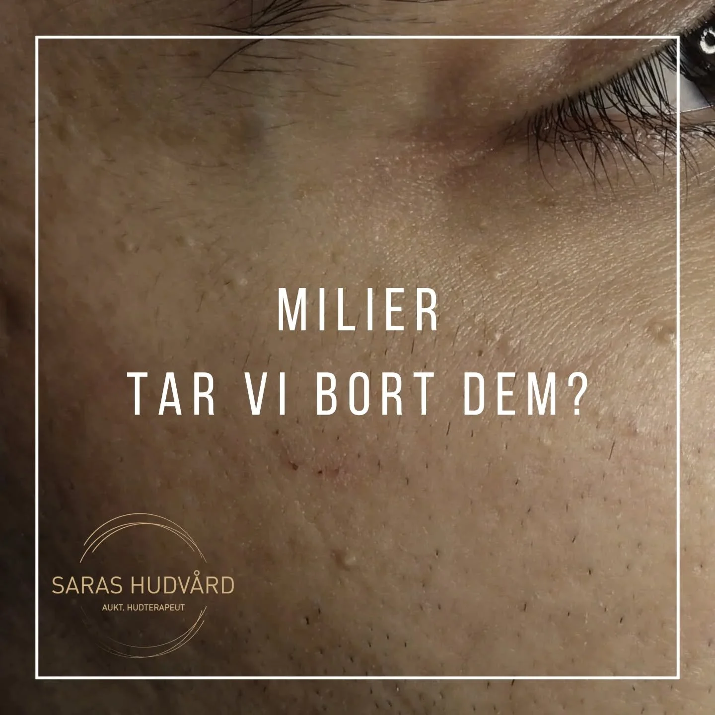 Milier!
Vi f&aring;r ofta fr&aring;gan om vi tar bort milier.

F&ouml;r oss som hudterapeuter &auml;r det en sj&auml;lvklarhet att borttagning av milier ing&aring;r i en ansiktsbehandling. Men eftersom det &auml;r s&aring; sj&auml;lvklart f&ouml;r os