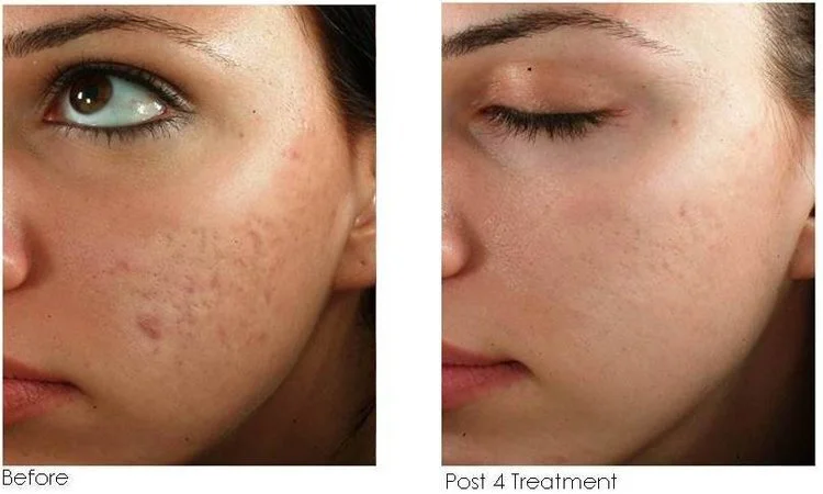 Before and after microneedling at Fine Line skincare studio in Seattle, showing smoother skin texture