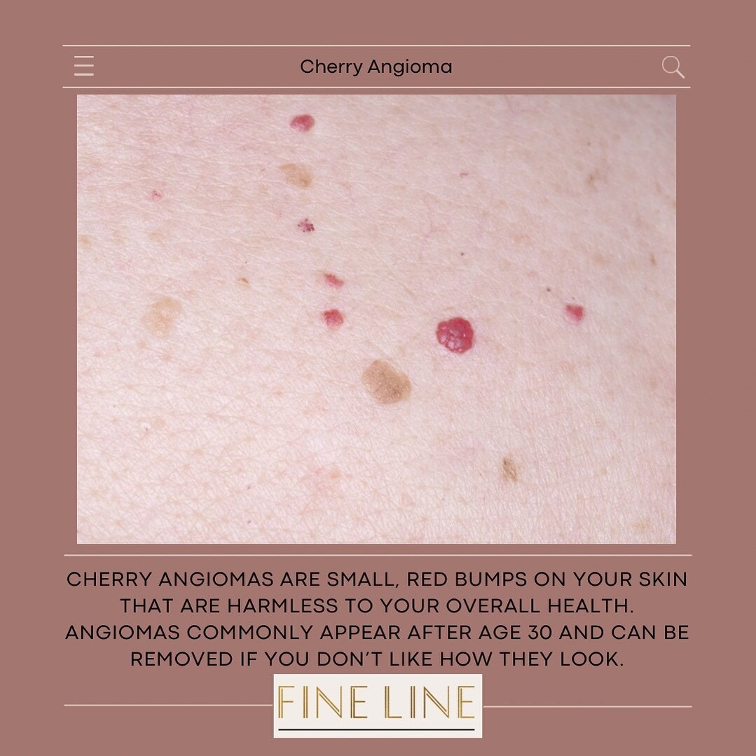 These tend to show up on the trunk and multiply with age. Completely harmless but you can say goodbye to cherry angiomas! 🍒✨ That&rsquo;s right&hellip; our in-office treatments make it easy to tackle these. Schedule your appointment today 📆 

.

.
