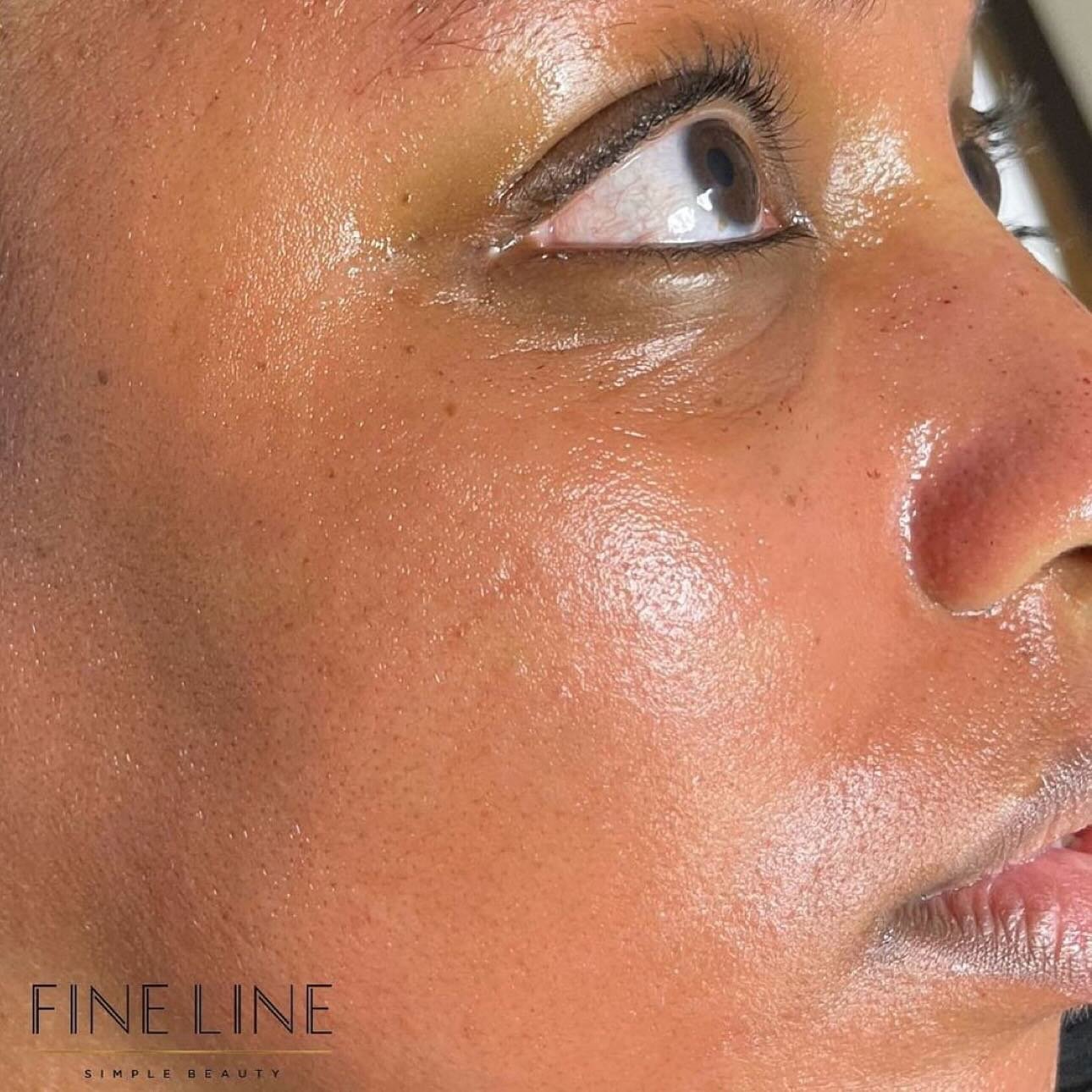 ❓When it comes to microneedling, do you ever wonder &ldquo;𝐖𝐡𝐚𝐭 𝐧𝐞𝐞𝐝𝐥𝐞 𝐝𝐞𝐩𝐭𝐡 𝐬𝐡𝐨𝐮𝐥𝐝 𝐈 𝐮𝐬𝐞?&rdquo;&hellip;..
💡We need to discuss clinical endpoints. Clinical endpoints are immediate or early tissue reactions that occur during