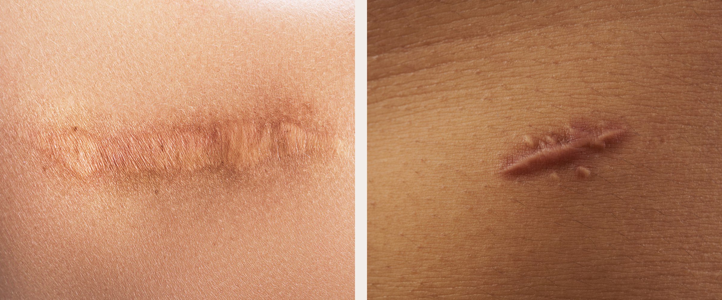 Two healed surgical scars on different skin tones, one flat and one raised, the kinds of scars microneedling can soften