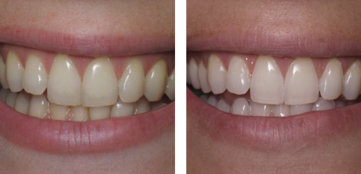  Teeth whitening 