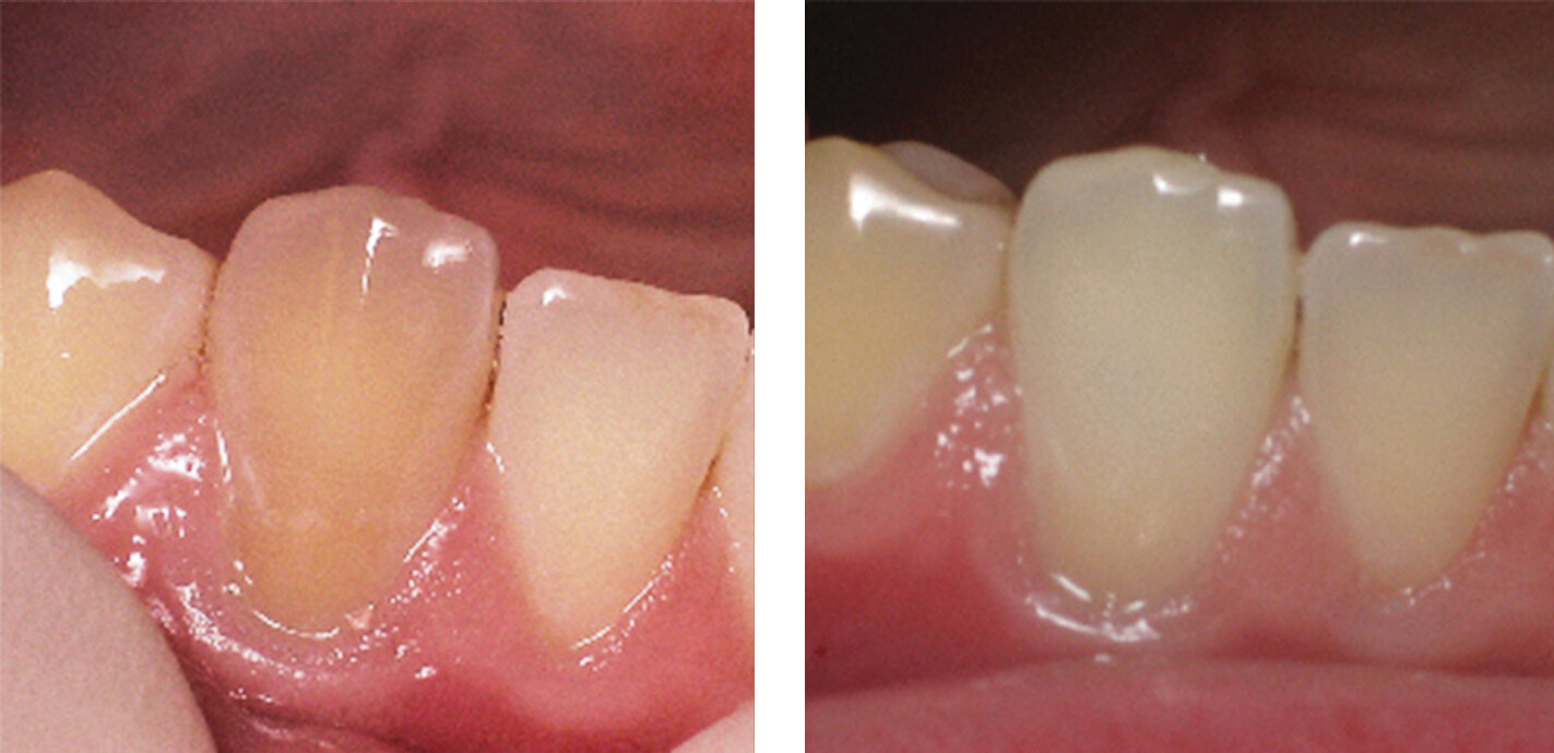  Individual tooth whitening 
