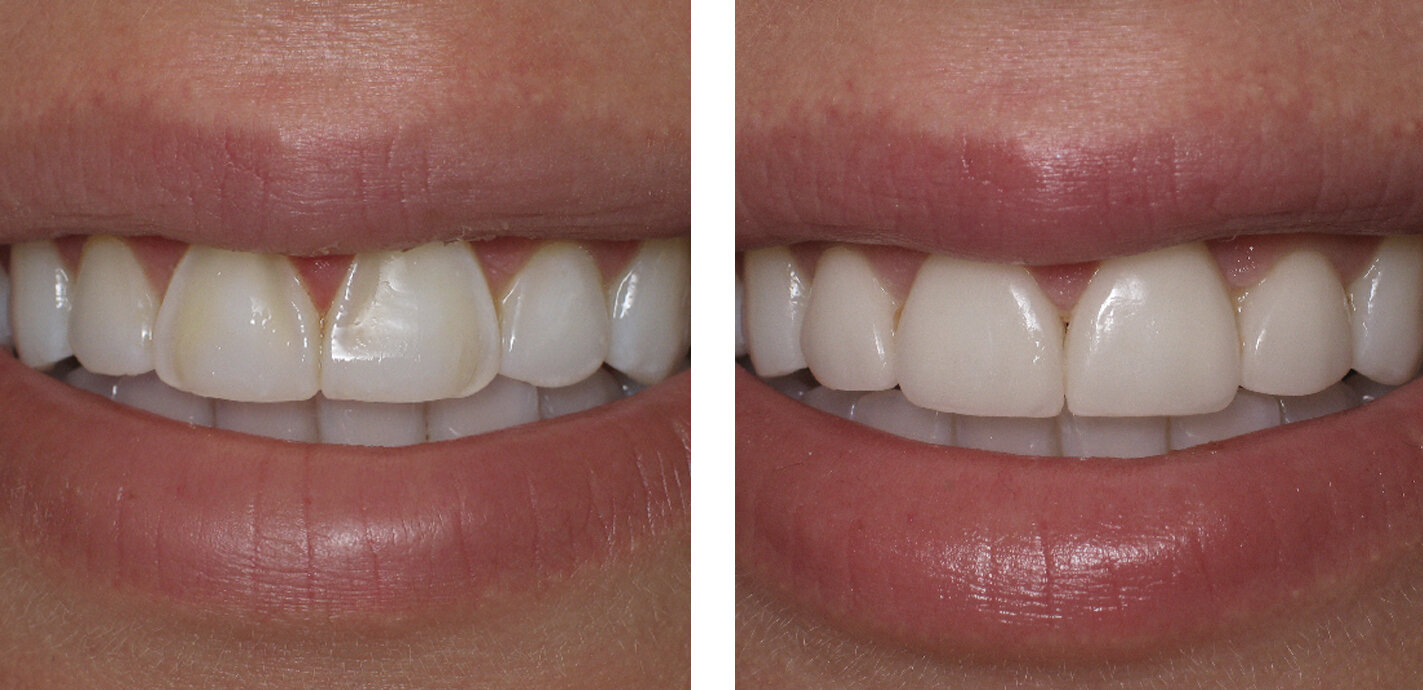  Veneers 