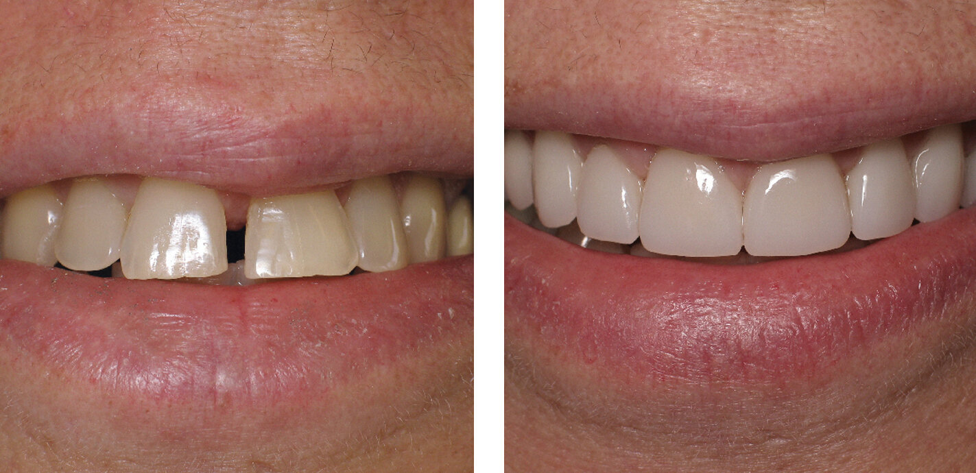  Orthodontics and veneers 