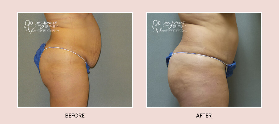 BeforeAfterTemplate-Abdominoplasty5.jpg