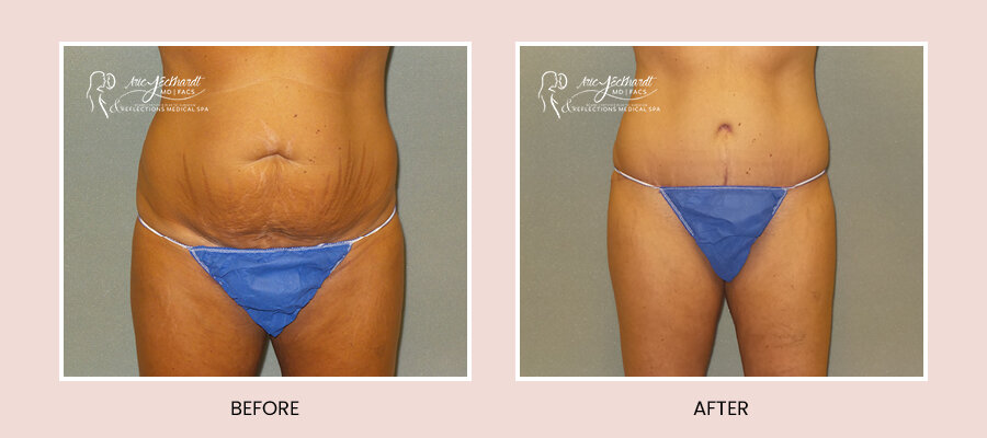 BeforeAfterTemplate-Abdominoplasty.jpg