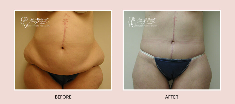 BeforeAfterTemplate-BeltLipectomy5.jpg