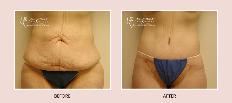 BeforeAfterTemplate-BeltLipectomy4.jpg