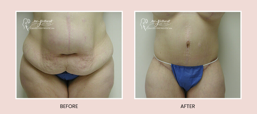 BeforeAfterTemplate-BeltLipectomy3.jpg