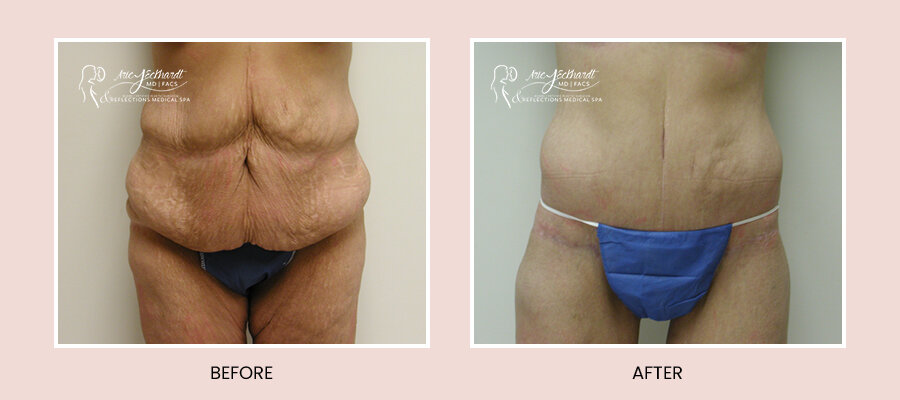 BeforeAfterTemplate-BeltLipectomy.jpg