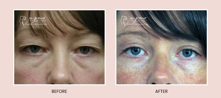 BeforeAfterTemplate-Blepharoplasty7.jpg