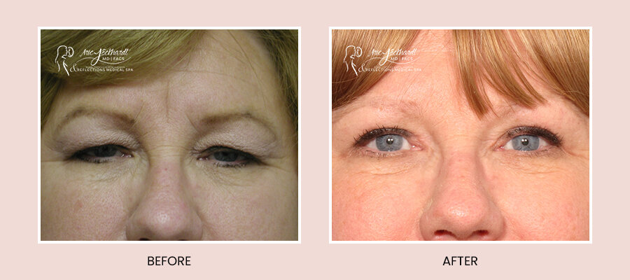 BeforeAfterTemplate-Blepharoplasty4.jpg