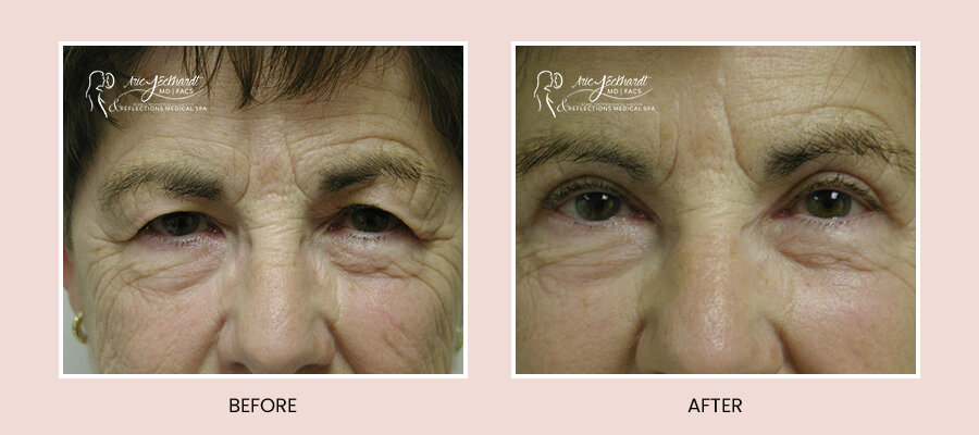 BeforeAfterTemplate-Blepharoplasty2.jpg