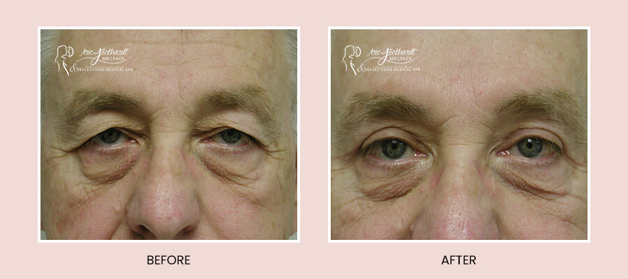 BeforeAfterTemplate-Blepharoplasty.jpg