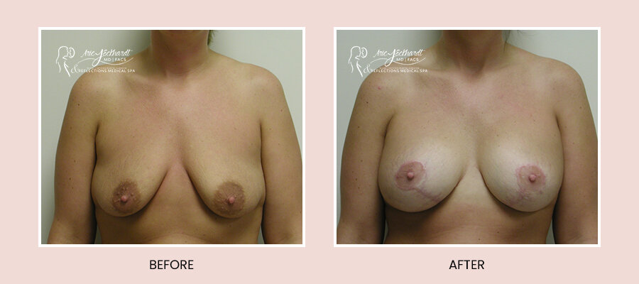 BeforeAfterTemplate-BreastAugLift5.jpg