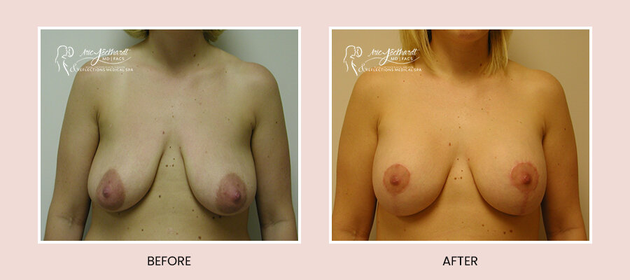 BeforeAfterTemplate-BreastAugLift2.jpg