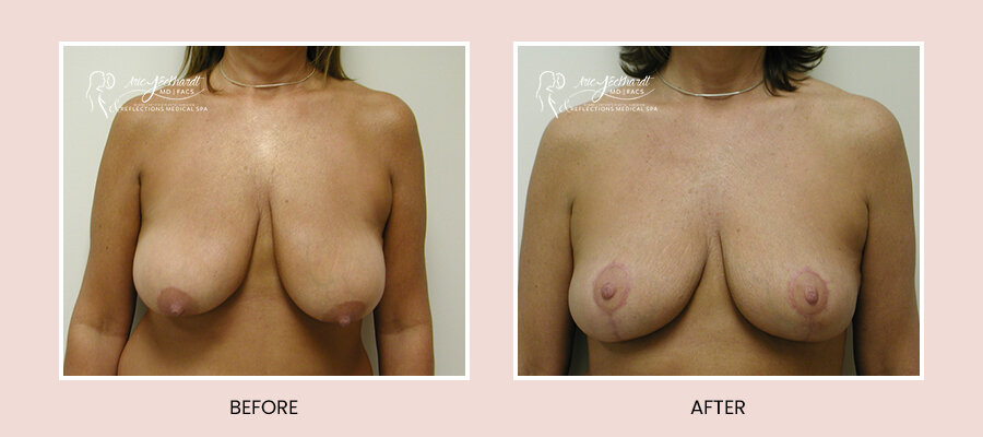 BeforeAfterTemplate-BreastLift3.jpg