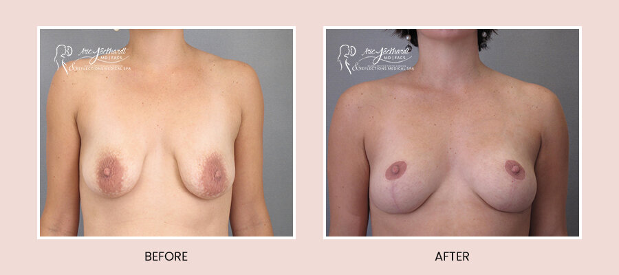 BeforeAfterTemplate-BreastLift2.jpg