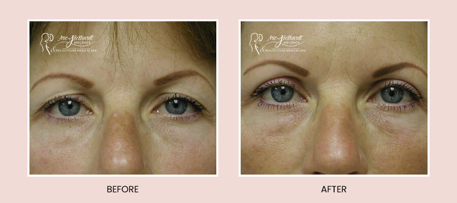 BeforeAfterTemplate-BrowLift.jpg